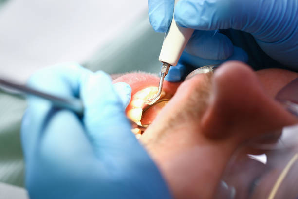 Best Emergency Dental Care for Sports Injuries in Glenmont, MD